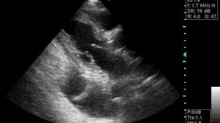 ultrasound BILATERAL PLEURAL EFFUSIONwmv [upl. by Burny133]