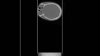 Radon Transform Head [upl. by Herstein140]