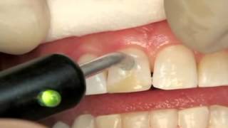 Endodontics Torabinejad 59 Electrical PulpTest [upl. by Gaye]