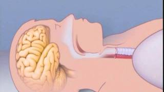 What Is Sleep Apnea [upl. by Melvena]