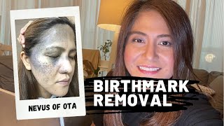 9th Session  Nevus of Ota Birthmark Removal using Laser  Qswitch NDYag [upl. by Iolenta]