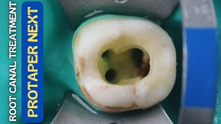 Root Canal Treatment in Mandibular Molar ⚪️ Protaper Next 🔵 Step By Step Demonstration [upl. by Ayikat]