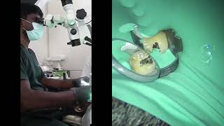 Ergonomic Endodontics with Dental Microscope [upl. by Revlis]