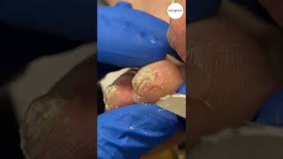 Tip of Toe Callus Removal by Podiatrist [upl. by Eciuqram1]