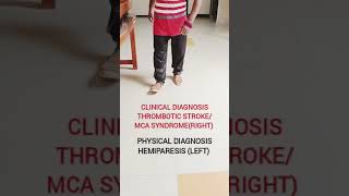 Physical diagnosisHemiparesis Leftcvastrokeneurologyphysiotherapylearningmriscanrehabumn [upl. by Rahel]