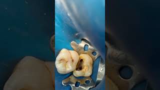 Molar 🦷 root canal treatment dentist dental dentalprocedure [upl. by Suellen]