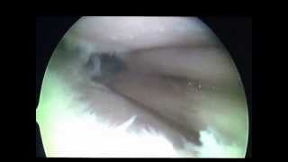 MIKRS Orthoglide Step 2 Mini Arthrotomy 15 20 inch opening of knee joint part1 [upl. by Eglanteen83]