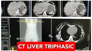 CT Liver Triphasic Scan [upl. by Ella158]