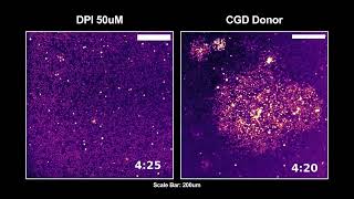 Disorganized Calcium waves in patient neutrophils during swarming [upl. by Snahc665]