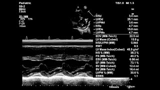 Basic echocardiography심장 초음파 기본 Parasternal short axis에서 M mode 측정 [upl. by Adiela718]