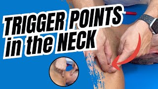 NECK PAIN RELIEF in 6 Minutes with STERNOCLEIDOMASTOID TRIGGER POINTS [upl. by Fessuoy]