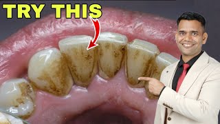 1 Simple Home Remedy For Yellow Teeth Dental Plaque Cavities [upl. by Luy]