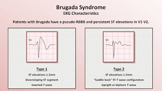 Advanced EKGs  Sudden Cardiac Death Hypertrophic cardiomyopathy ARVD Brugada syndrome and CPVT [upl. by Ebbie]