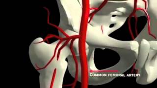 Peripheral Artery Disease [upl. by Iolenta]