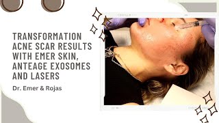 TRANSFORMATION ACNE SCAR RESULTS WITH EMER SKIN ANTEAGE EXOSOMES AND LASERS  Dr Emer amp Rojas [upl. by Rialc]