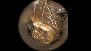 123  Fully Blocked amp Impacted Ear Wax Removal from Narrow Bendy Ear using the WAXscope®️ [upl. by Nalor]