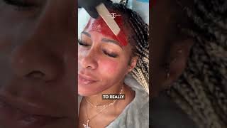 Fabulous Shereé Whitfield gets her second MelanX Chemical Peel 💥 The Real Housewives of Atlanta st [upl. by Llered32]