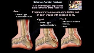 Calcaneal Avulsion Fractures  Everything You Need To Know  Dr Nabil Ebraheim [upl. by Yenitirb]