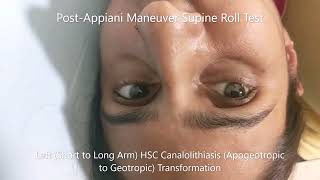 Transformation of Apogeotropic Horizontal Canal BPPV to Geotropic Variant [upl. by Norvil]