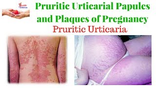 Pruritic Urticarial Papules and Plaques of Pregnancy  Pruritic Urticaria [upl. by Renfred950]