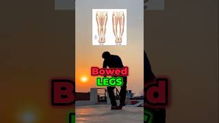 ✅bowed legs exercises DAY 10 🦍armylover trending bowedlegs motivation desiworkout [upl. by Mitinger]