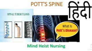 Potts Spine Medical SurgicalExplained in Hindi [upl. by Kristina]