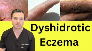 What is Dyshidrotic hand Eczema Causes and treatment [upl. by Broeder]