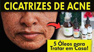 5 ÓLEOS Potentes para TRATAR CICATRIZES DE ACNE PROFUNDAS E ANTIGAS EM CASA [upl. by Aihsakal]