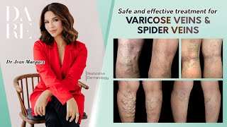 Varicose Veins Treatment Foaming Sclerotherapy [upl. by Alliw]