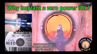 Why implant a zero power IOL in very myopic cataract surgery [upl. by Mellie]