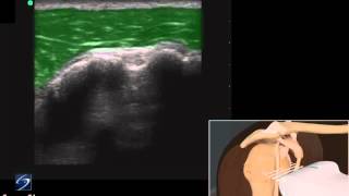 How To Shoulder Biceps Tendon 3D Video [upl. by Hussey646]