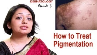 How to Treat Skin Pigmentation Episode 3 [upl. by Kelcie]