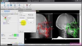 AudaxCeph  Manual Superimposition [upl. by Nehgem226]