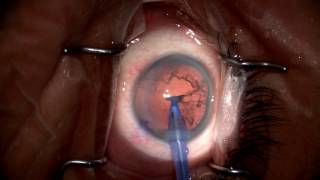 Basic Monofocal IOL Cataract Surgery  Brooks Eye Associates [upl. by Yaluz583]