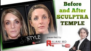 Watch Sculptra Injected Temples  Before and After Sculptra [upl. by Adilen718]