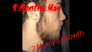 MINOXIDIL BEARD 2 month of GROWTH 4 months of use TIMELAPSE [upl. by Ruy]