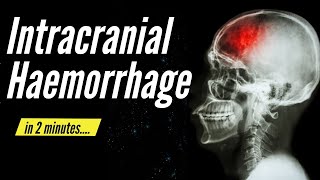 Intracranial Haemorrhage in 2 minutes [upl. by Peadar]