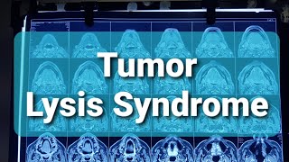 Tumor Lysis Syndrome [upl. by Erapsag935]