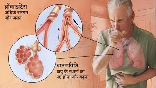 Asthacare Respules Review How To Get Relief From COPD amp Asthma [upl. by Aihsekat69]