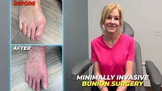 Minimally Invasive Bunion Surgery Patient Testimonials [upl. by Shlomo]