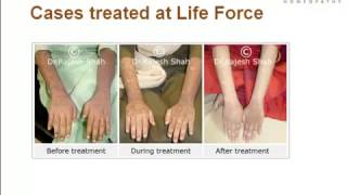 What is Lichen Planus Presentation By Experts at Life Force [upl. by Aryajay570]