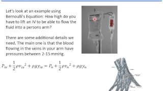 8 Fluid Dynamics  Example  IV fluid into a Vein [upl. by Reynolds]