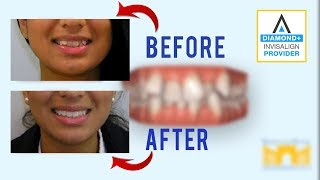 Invisalign Before and After Crowded Teeth [upl. by Eneleh]