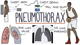 Pneumothorax [upl. by Balthazar]