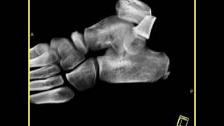 Musculoskeletal Calcaneus fracture Volume rendering [upl. by Llerryt]