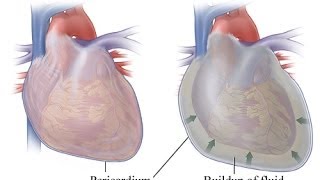 My Pericarditis or Heart Fluid Buildup I think it was caused by an infection It happened suddenly [upl. by Adieren231]