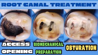 Root Canal Treatment 🔵 Mandibular Molar 🟡Access Opening🟢Biomechanical Preparation ⚪️ Obturation [upl. by Courcy138]