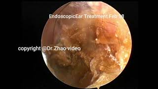 Plain cerumen and external auditory canal cholesteatoma re cleaned 13 minutes [upl. by Shiverick]