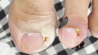 Treatment for Ingrown Toenails 001 satisfying nails [upl. by Rammus]