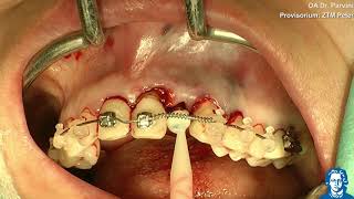 Ankylos 2018Parvini Implantation amp Immediate restoration 22 Soft tissue management with CTG [upl. by Ardnovahs422]